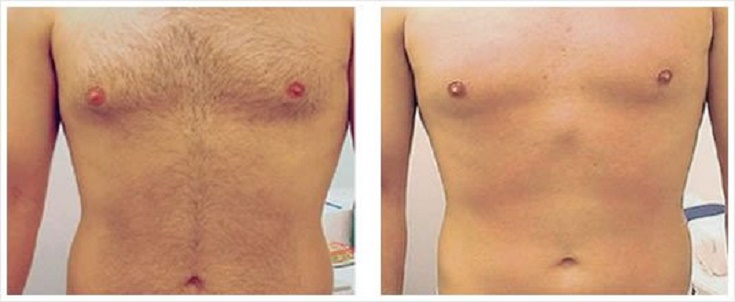 abs-before-after-laser-hair-removal
