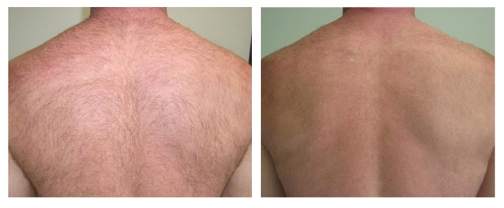 Before And After Renova Laser Hair Removal MedSpa Houston TX