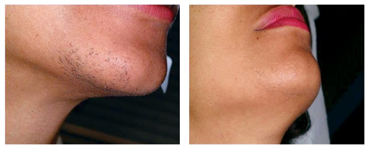 chin-before-after-laser-hair-removal