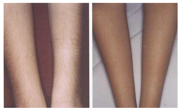 Before And After Renova Laser Hair Removal MedSpa Houston TX before-and-after-renova-laser-hair-removal-medspa-houston-tx
