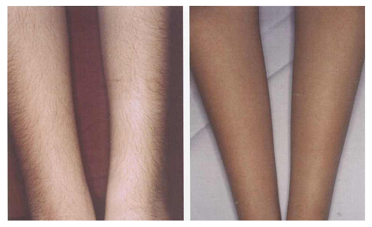 Before And After Renova Laser Hair Removal MedSpa Houston TX