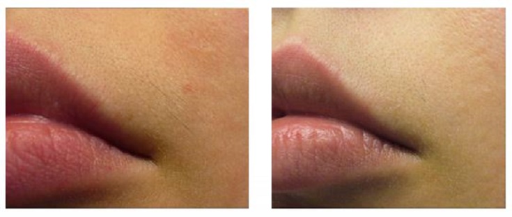 lip-before-after-laser-hair-removal