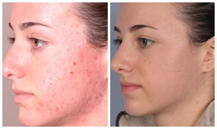 microdermabrasion-before-after-1