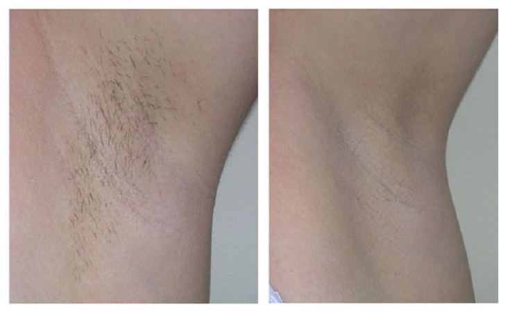 underarms-before-after-laser-hair-removal