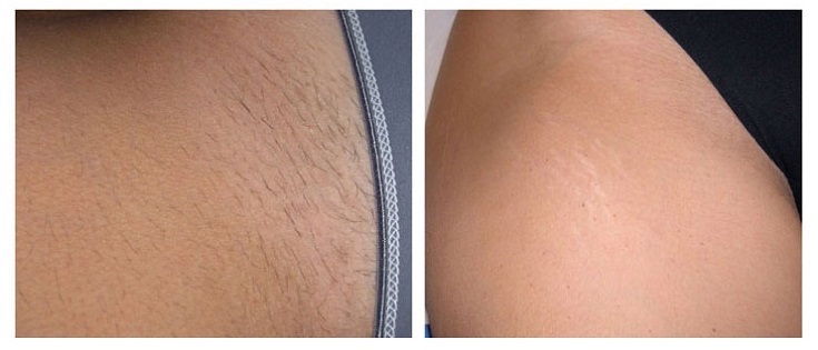 Pubic Full Brazilian Laser Hair Removal Before And After Photos Best Hairstyles Ideas For 