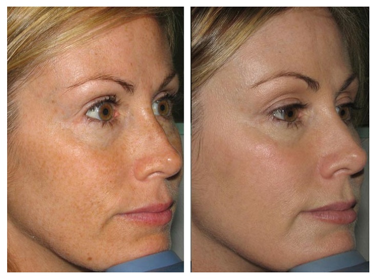 Before and After | Renova Laser Hair Removal & MedSpa Houston TX