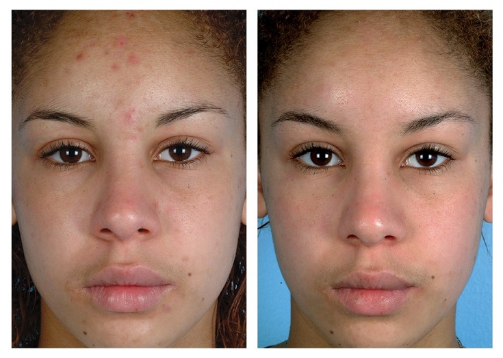 Before and After | Renova Laser Hair Removal & MedSpa ...